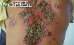 膿皰型牛皮癬瘙癢怎么辦